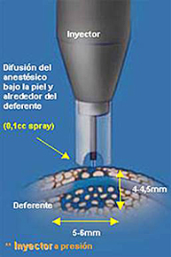 Inyector