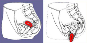 Vaginoplastia