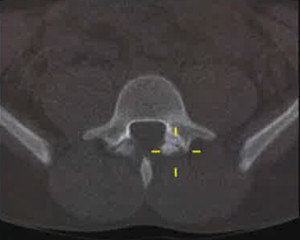 TAC-espondilolisis