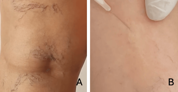Escleroterapia