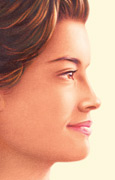Rinoplastia después