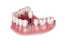 implantes