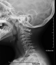 rx_cavum