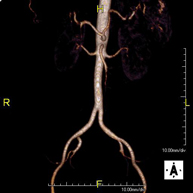 Angio RM Aorta-ilíaca