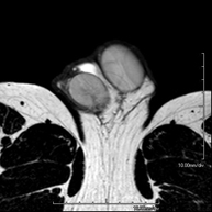 RM Escrotal (testicular)