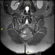RM de Sacroilíaques