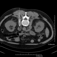 PAAF (Punción) Abdominal guiada por TC