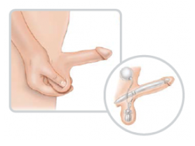 implantes protesis pene