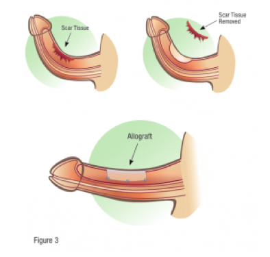tecnicas parche tratamiento peyronie