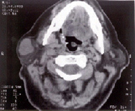 Tumor Mixto de Parótida