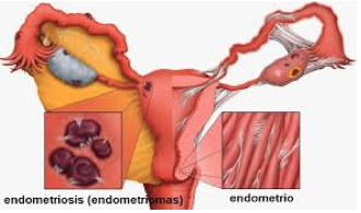 Endometriosis