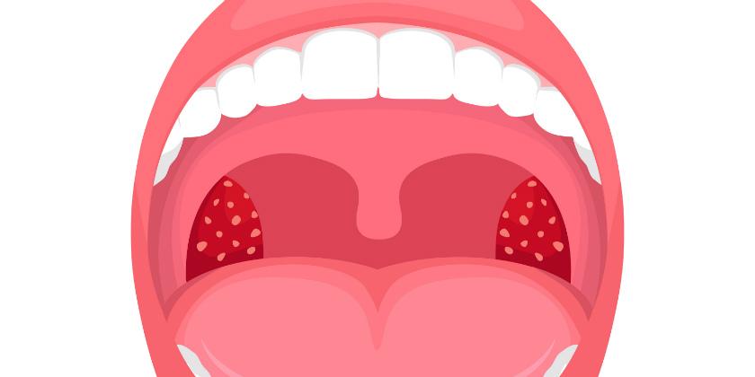 infecciones-de-repetición-amigdalas