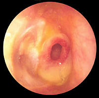 Perforación pequeña del tímpano