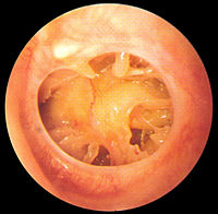 Perforación grande del tímpano