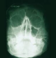 Desórdenes nasales4