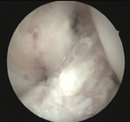 Lesiones ligamentosas