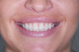 carillas de porcelana sonrisa antes