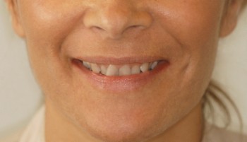 dientes antes