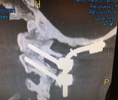 Occipitocervical fusion