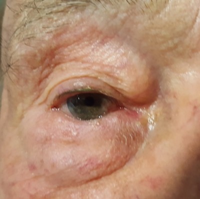 entropion
