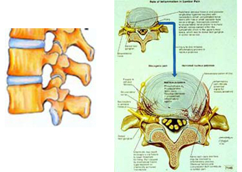 Columna lumbar degenerativa