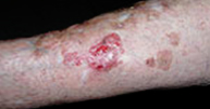 Lesión de carcinoma superficial en la pierna