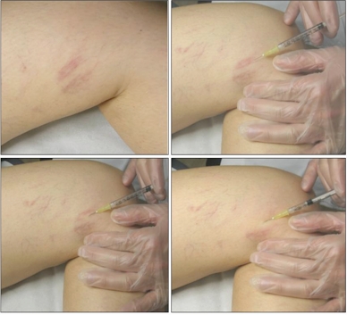 tecnica microesclerosi