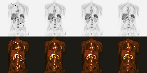 cancer_pros_pruebas_2