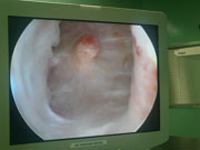 ablacion prostatica_2