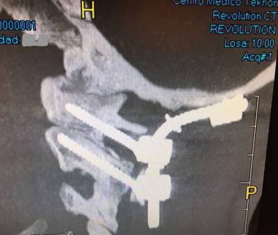 Occipitocervical fusion