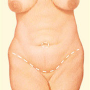 Abdominoplastia-antes