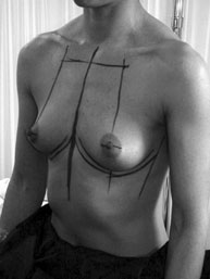 Paciente-para-aumento-de-senos