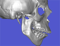 Técnica Surgery First1