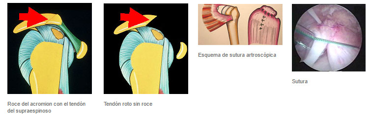 Síndrome subacromial