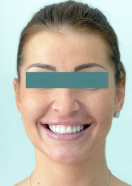 carillas de porcelana rostro entero antes