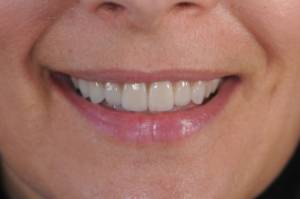 dientes centrados después