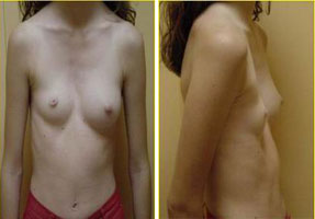 Imagen-preoperatorio-Nuss