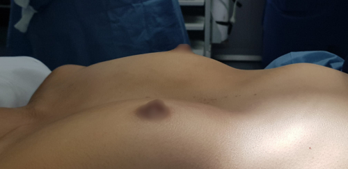 Imatge Web Molins Abans Pectus Up