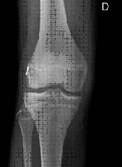 Lesiones ligamentosas