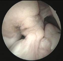 Lesiones ligamentosas
