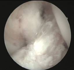 Lesiones ligamentosas