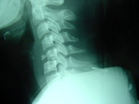 Fractura luxación a nivel de las vértebras cervicales por un accidente de tráfico.