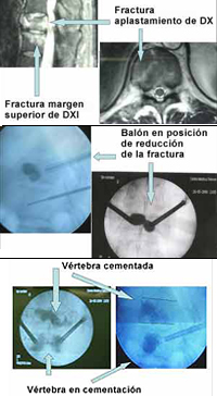 Cifoplastia_03