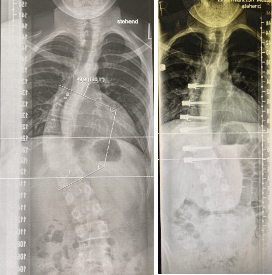 placas rayos x escoliosis