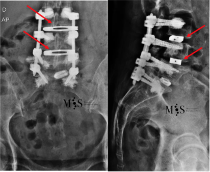 corrección post-operatoria de la escoliosis con sendas cajas OLIF