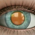 Oftalnova_Oftalmologos_Barcelona_Cataratas_Ojo_con_catarata-150x150