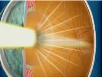 Oftalnova_oftalmologos_Barcelona_Cataratas_reflejo_luz