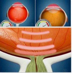 Oftalnova_Oftalmologia_Barcelona_Glaucoma_causas_soluciones.jpg-296x300