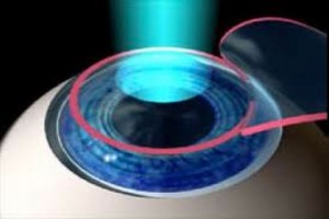 Laser_Excimer_Oftalnova_Oftalmologia_Barcelona-300x200