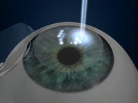 Queratectomía con láser excímer Lasik